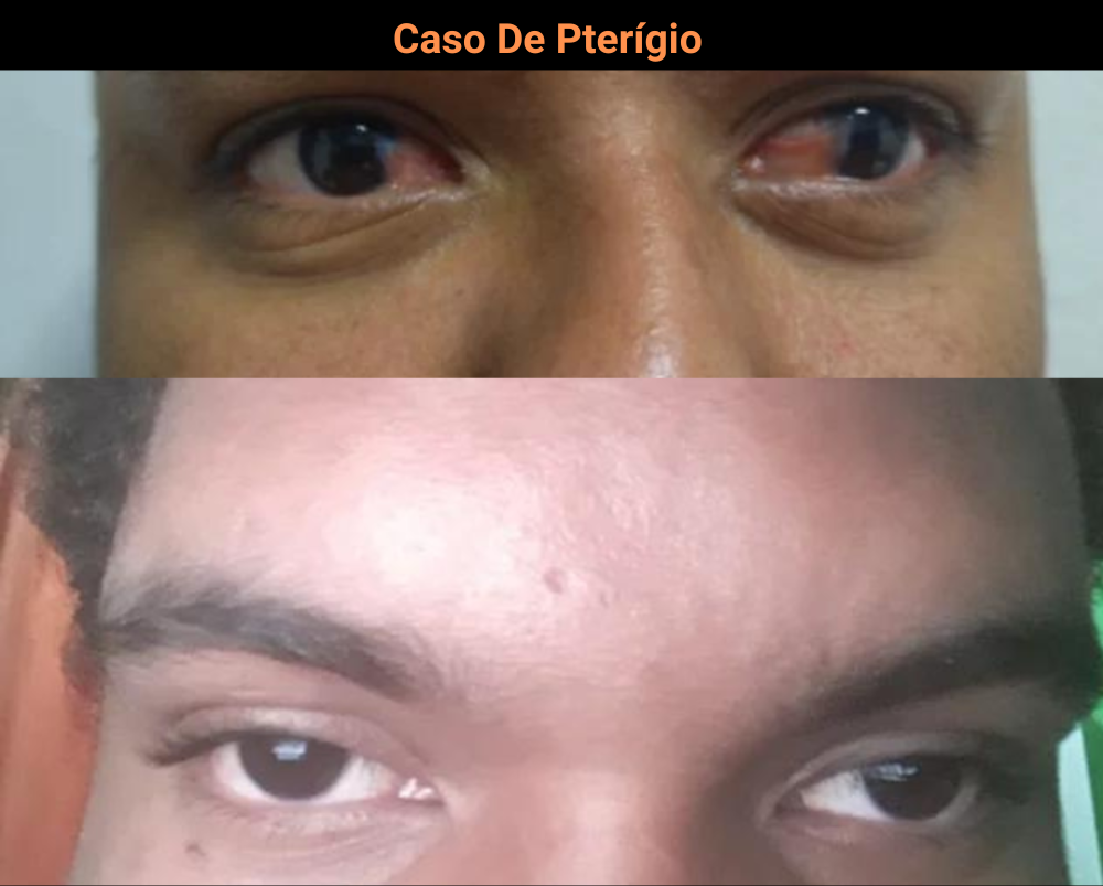 Caso-De-Pterigio-1.png